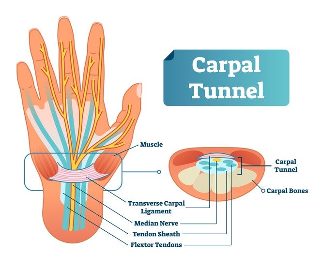 Surprising statistics about carpal tunnel syndrome