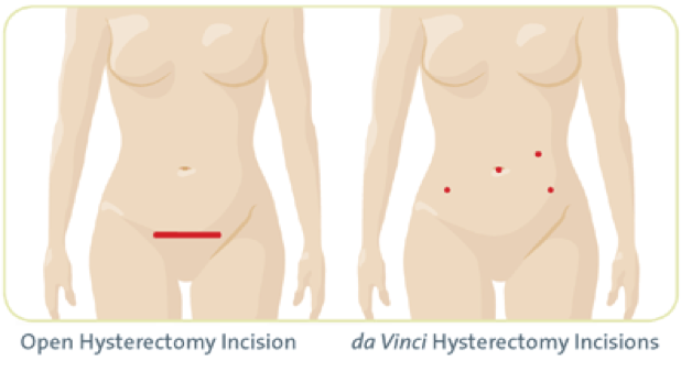 da Vinci hysterectomy