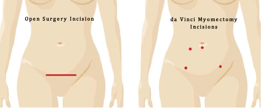 da vinci fibroid surgery