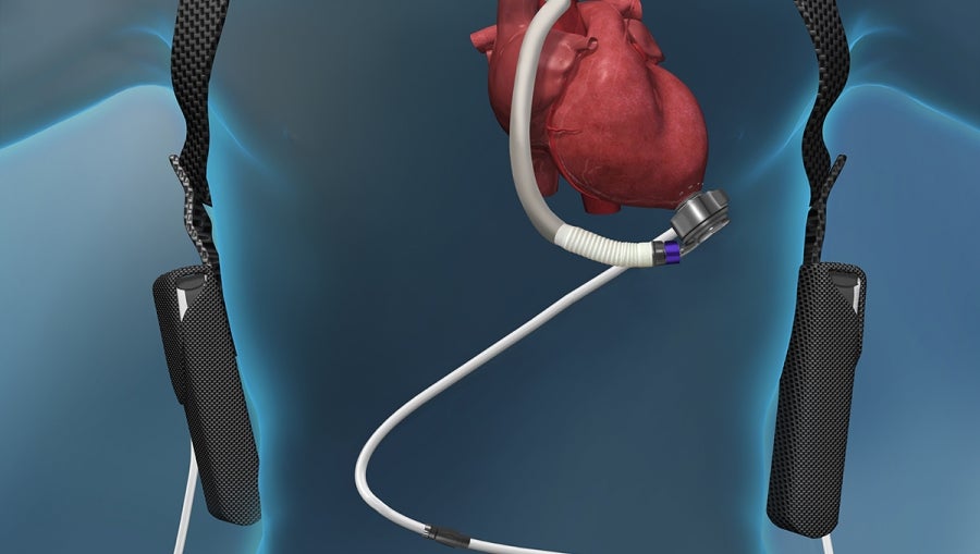 LVAD External Equipment Pocket Controller